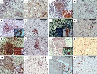 Chronic Hepatitis C Pathogenesis: Immune Response in the Liver Microenvironment and Peripheral Compartment